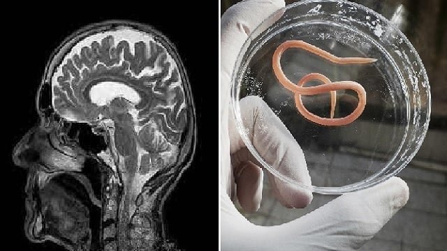 ऑस्ट्रेलिया में इंसानी दिमाग से निकला आठ सेंटीमीटर लंबा जिंदा कीड़ा| Viral News