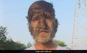 भालू जैसा है इस शख्स का पूरा शरीर, ‘मंकी मैन’ कहकर बुलाते हैं लोग, लड़के ने बयां किया बीमारी का दर्द