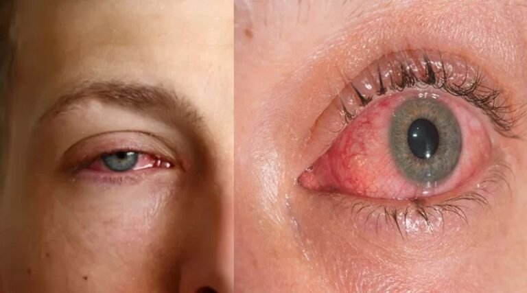 Conjunctivitis: तेजी से फैल रहा Eye Flu का इंफेक्शन, जानिए इससे बचने का तरीका !