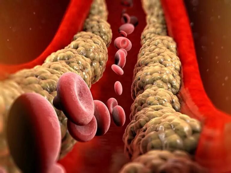 cholesterol| बढ़ने से क्या होता है| कैसे बचें